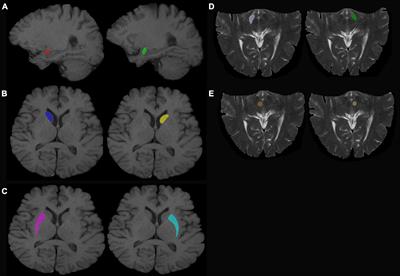 Development and Validation of a Plasma FAM19A5 and MRI-Based Radiomics Model for Prediction of Parkinson’s Disease and Parkinson’s Disease With Depression